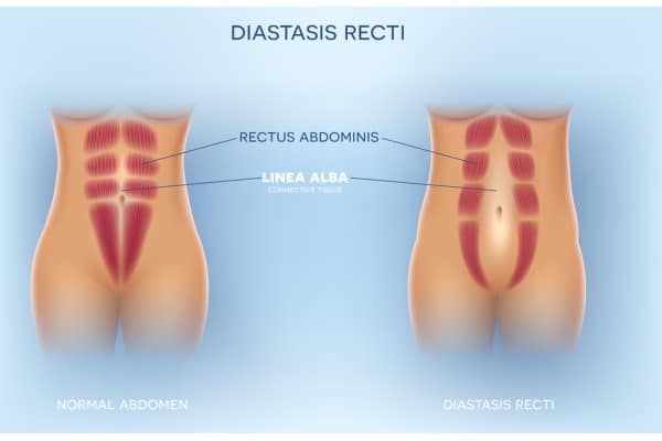 What Non-Surgical Options Are Available for Diastasis Recti Daventry?