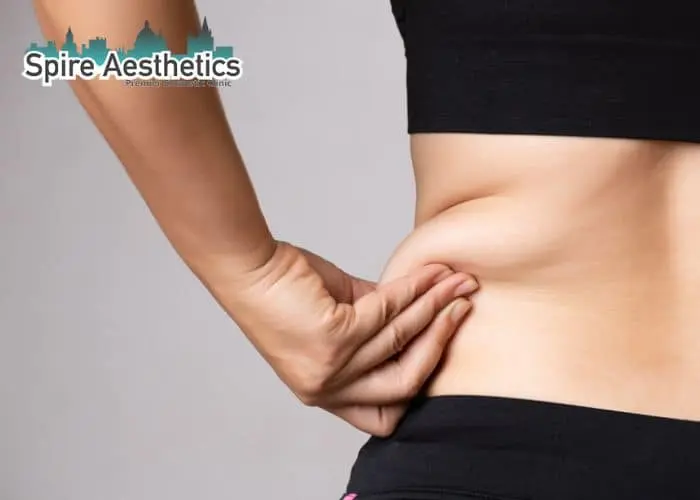 Image of woman pinching fat on their hips Daventry. Fat Freezing treatment