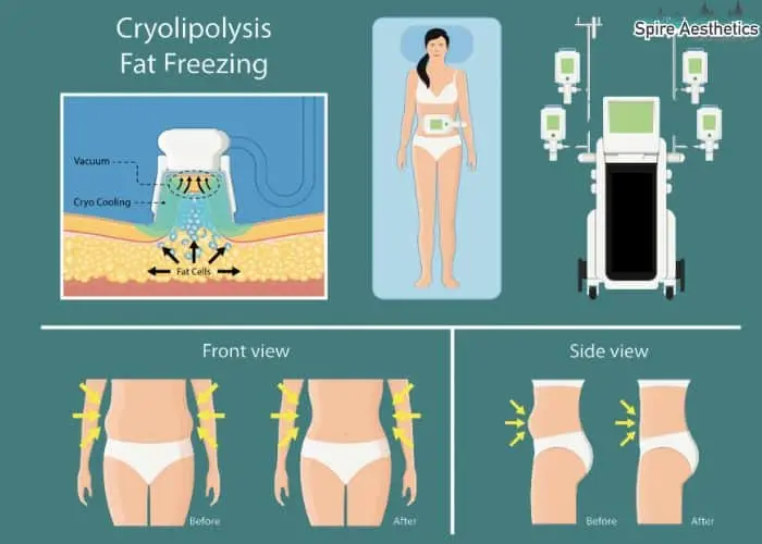 Fat freezing treatment Daventry benefits for competitions to remove stubborn fat deposits.