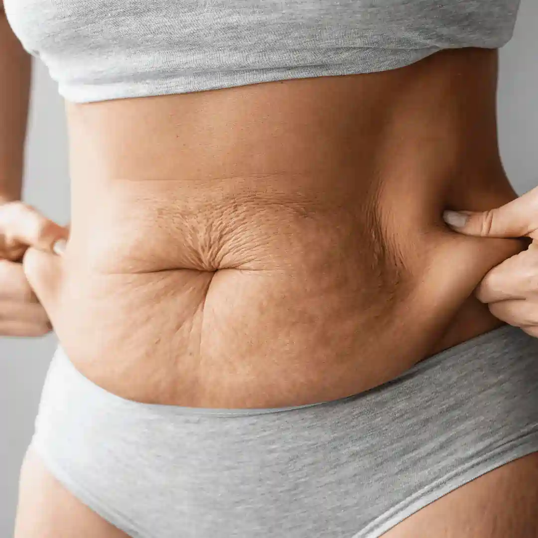 Is It Normal to Have Loose Skin After Pregnancy Daventry?