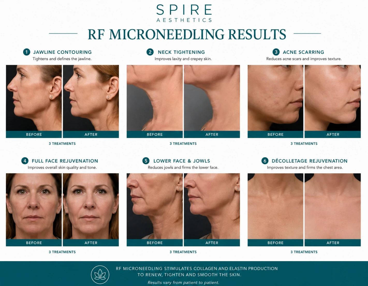 RF Microneedling Skin tightening Daventry results