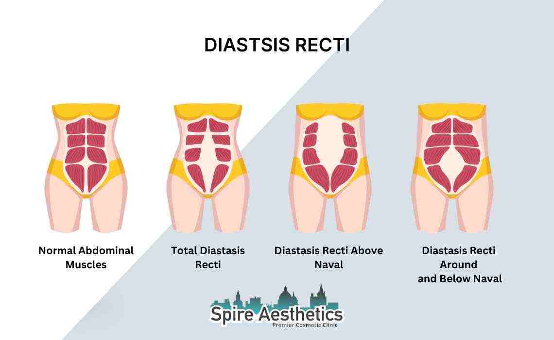Is Non-Surgical Diastasis Recti Treatment Right for You? Common Concerns Answered Daventry